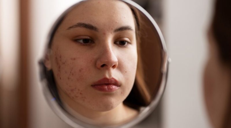 Acne se torna cada vez mais comum entre mulheres adultas