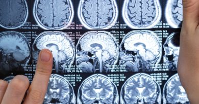 Neurocirurgião esclarece dúvidas sobre tumor cerebral