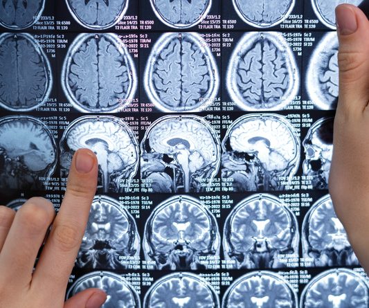 Neurocirurgião esclarece dúvidas sobre tumor cerebral